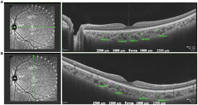 Pattern of choroidal thickness in early-onset high myopia